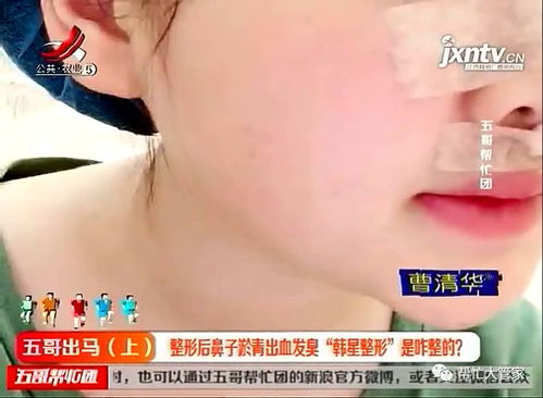 整形后鼻子淤青出血发臭 新余 韩星整形 咋整的