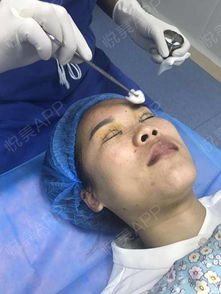 我是天生的小...眼综合 悦美整形